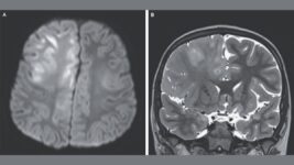 This Is What a Brain Destroyed by Measles Looks Like