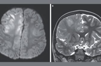 This Is What a Brain Destroyed by Measles Looks Like