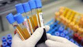 Simple Blood Test Can Predict Dementia 25 Years in Advance, Study Suggests